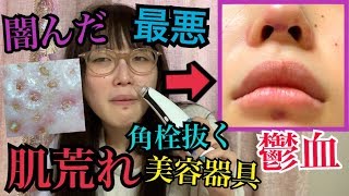 【角栓】鼻の角栓抜き美容器具使ったら最悪な結果になった‼最強のコンシーラー比較‼‼