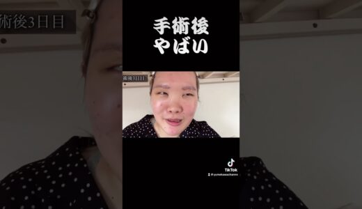 ふくれなに似てるってよく言われる #一重整形 #眼瞼下垂 #二重整形 #眼瞼下垂 #逆さまつげ #手術 #ふくれな #保険適用 #DT #ダウンタイム